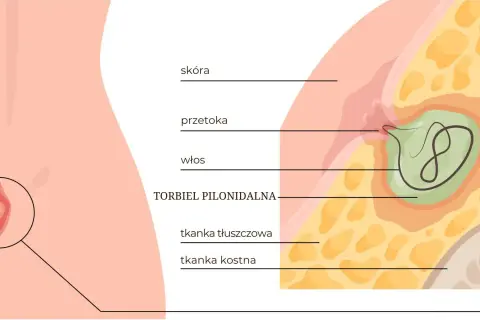 Ilustracja anatomiczna torbieli pilonidalnej z widocznym włosem i przetoką.