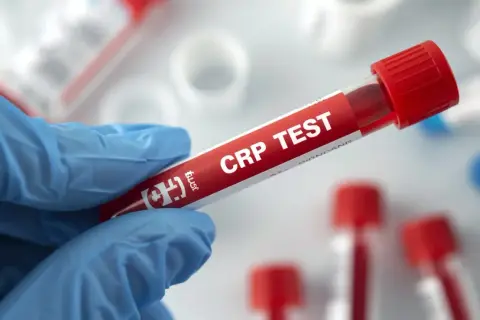 Rękawiczka trzyma probówkę z krwią do badania CRP. Cena tego testu jest kluczowa dla diagnostyki.