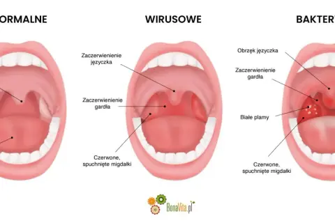 Porównanie gardła: normalne, wirusowe i bakteryjne. Widoczne migdałki, język i gardło.