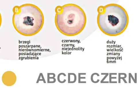 ABCDE czerniaka: asymetria, brzegi, kolor, duży rozmiar, ewolucja.