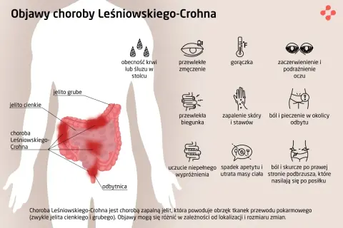 Ilustracja przedstawia schemat jelit z zaznaczonymi objawami choroby Leśniowskiego-Crohna.