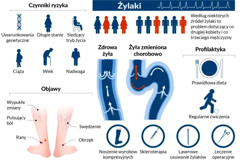 Grafika przedstawia żylaki, ich objawy, czynniki ryzyka (genetyka, ciąża, wiek, nadwaga, długie stanie, siedzący tryb życia) oraz profilaktykę (dieta, ćwiczenia, wyroby kompresyjne, skleroterapia, laser, operacja).