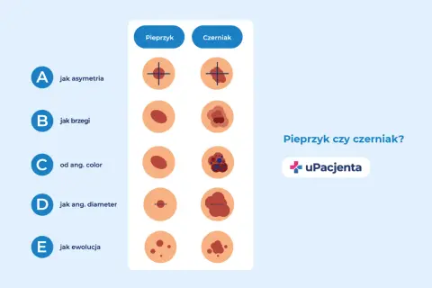 Ilustracja porównująca pieprzyk i czerniaka według kryteriów ABCDE.
