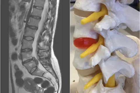 MRI kręgosłupa lędźwiowego i model anatomiczny ukazujący ucisk na nerw. Obraz pomaga zrozumieć zapalenie krążka międzykręgowego objawy.