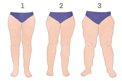 Ilustracja przedstawiająca nogi kobiet z różnym stopniem lipodemi.