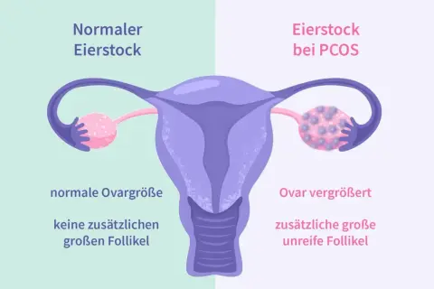 Porównanie jajnika: normalny jajnik z małą liczbą pęcherzyków vs. jajnik przy PCOS z licznymi, dużymi, niedojrzałymi pęcherzykami.