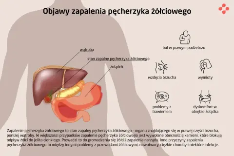 Ilustracja anatomiczna przedstawiająca wątrobę, żołądek i pęcherzyk żółciowy z objawami zapalenia.