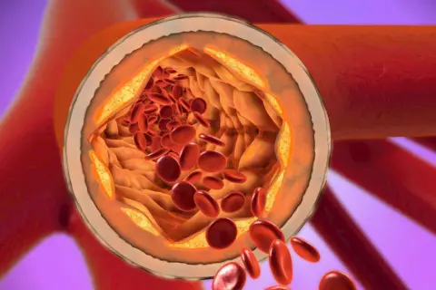 Przekrój tętnicy z widocznymi złogami cholesterolu i czerwonymi krwinkami.
