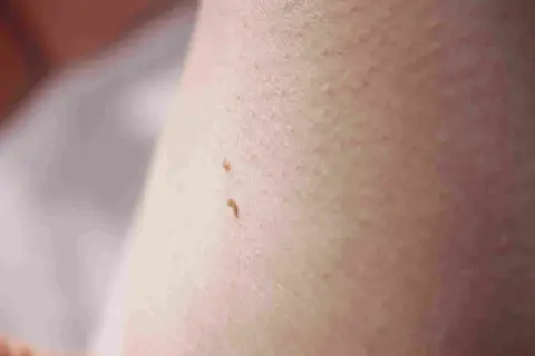 Zbliżenie na skórę z widocznymi dwoma małymi, brązowymi włókniakami.