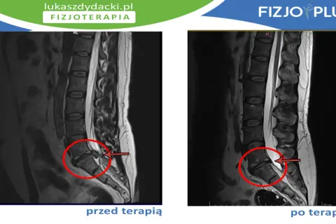 Rezonans magnetyczny kręgosłupa lędźwiowego przed i po terapii. Widoczna dyskopatia L5 S1 objawy, zaznaczone czerwonym okręgiem i strzałką.