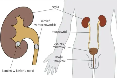 Czy alkohol przy kamicy nerkowej? Poznaj fakty i zagrożenia