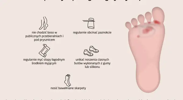 Ilustracja pokazuje sposoby zapobiegania grzybicy stóp: nie chodzić boso, myć stopy, obcinać paznokcie, unikać ciasnych butów, nosić bawełniane skarpety.
