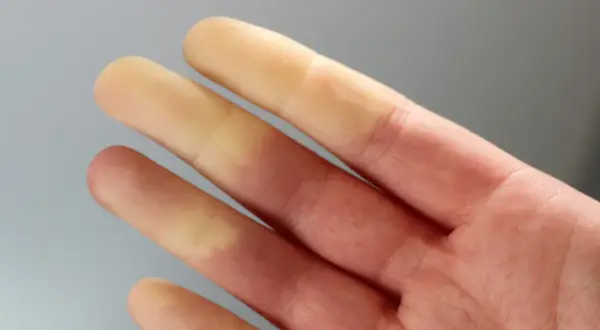 Palce dłoni z widocznym objawem Raynauda – blednące i czerwieniejące w reakcji na zimno.