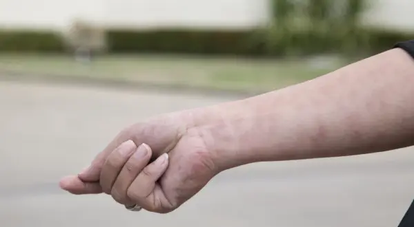 Różowe plamki na skórze ręki mogą być jednym z objawów białaczki.