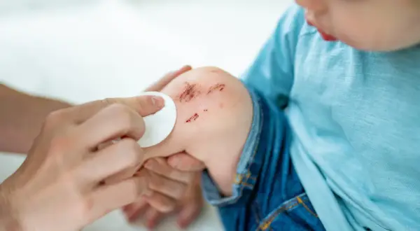 Dziecko z otartym kolanem, któremu przemywa się ranę. To przypomina, co to hemofilia i jak ważne jest dbanie o bezpieczeństwo.