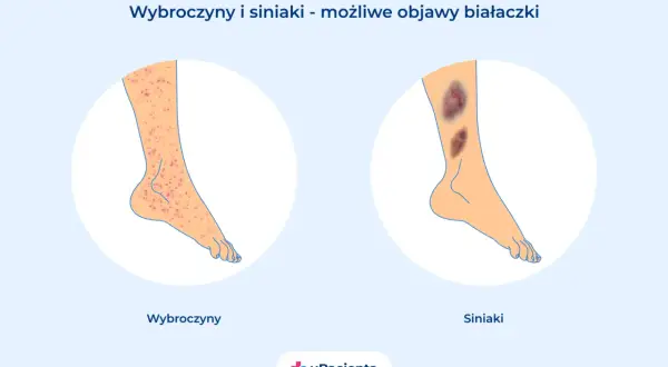 Wybroczyny i siniaki na nogach mogą być objawem białaczki. Ilustracja pokazuje nogę z licznymi czerwonymi plamkami (wybroczyny) i drugą nogę z dużymi, ciemnymi siniakami.