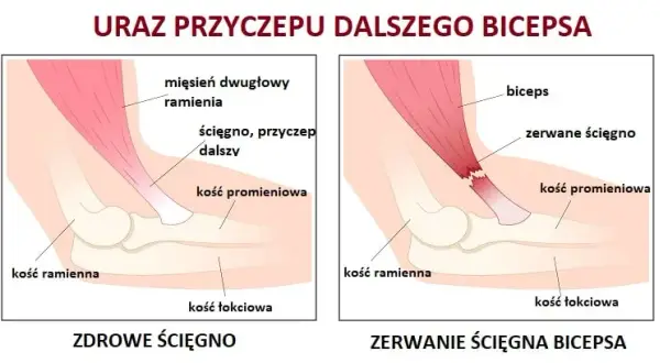 Naderwany biceps: 5 kluczowych objawów, które musisz znać