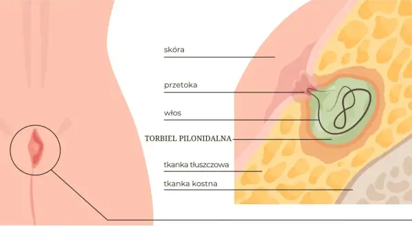 Ilustracja anatomiczna torbieli pilonidalnej z widocznym włosem i przetoką.