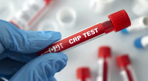 Rękawiczka trzyma probówkę z krwią do badania CRP. Cena tego testu jest kluczowa dla diagnostyki.