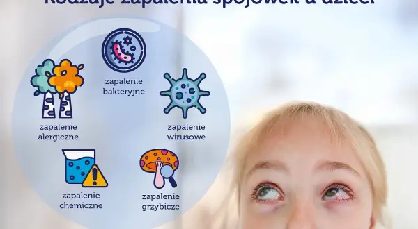 Rodzaje zapalenia spojówek u dzieci: alergiczne, bakteryjne, wirusowe, chemiczne, grzybicze.