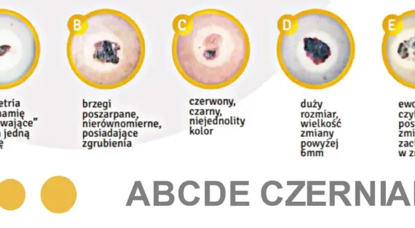 ABCDE czerniaka: asymetria, brzegi, kolor, duży rozmiar, ewolucja.