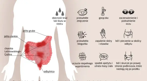 Ilustracja przedstawia schemat jelit z zaznaczonymi objawami choroby Leśniowskiego-Crohna.