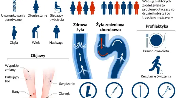 Grafika przedstawia żylaki, ich objawy, czynniki ryzyka (genetyka, ciąża, wiek, nadwaga, długie stanie, siedzący tryb życia) oraz profilaktykę (dieta, ćwiczenia, wyroby kompresyjne, skleroterapia, laser, operacja).