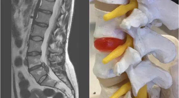 MRI kręgosłupa lędźwiowego i model anatomiczny ukazujący ucisk na nerw. Obraz pomaga zrozumieć zapalenie krążka międzykręgowego objawy.