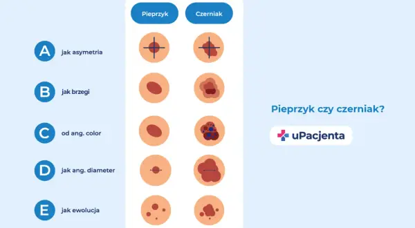 Porównanie znamion: łagodne pieprzyki vs. potencjalnie groźne czerniaki. Ilustracje pokazują różnice w asymetrii, brzegach, kolorze, średnicy i ewolucji.