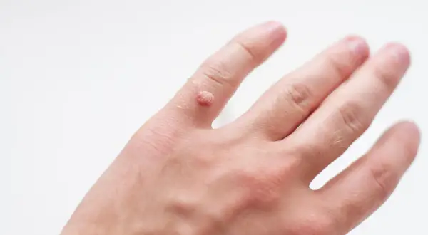 Czy można zarazić się kurzajką? Poznaj prawdę o infekcji HPV