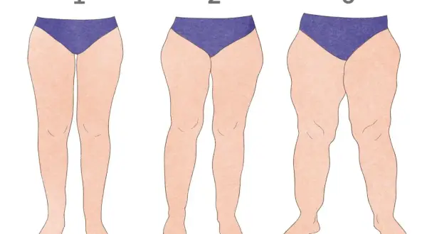 Ilustracja przedstawiająca nogi kobiet z różnym stopniem lipodemi.