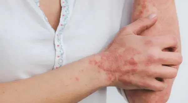 Skóra ręki i przedramienia pokryta suchymi, łuszczącymi się zmianami, które mogą być objawem pelagry.