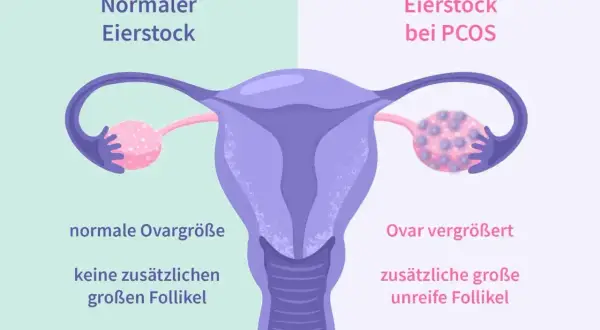 Porównanie jajnika: normalny jajnik z małą liczbą pęcherzyków vs. jajnik przy PCOS z licznymi, dużymi, niedojrzałymi pęcherzykami.