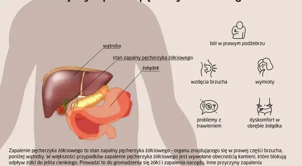 Ilustracja anatomiczna przedstawiająca wątrobę, żołądek i pęcherzyk żółciowy z objawami zapalenia.