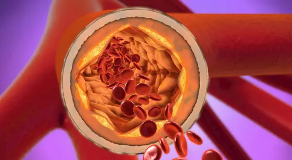 Przekrój tętnicy z widocznymi złogami cholesterolu i czerwonymi krwinkami.
