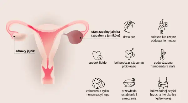 Ilustracja przedstawia budowę narządów rodnych kobiety z zaznaczonym zdrowym jajnikiem i stanem zapalnym jajnika. Wymienione objawy zapalenia jajników to m.in. ból brzucha.