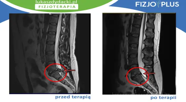 Rezonans magnetyczny kręgosłupa lędźwiowego przed i po terapii. Widoczna dyskopatia L5 S1 objawy, zaznaczone czerwonym okręgiem i strzałką.
