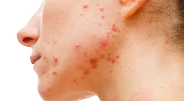 Zaburzenia hormonalne a objawy skórne: jak rozpoznać i leczyć problemy skóry