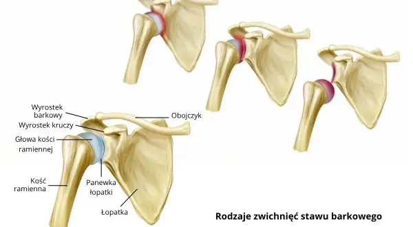Wybity bark: skuteczne metody leczenia i rehabilitacji