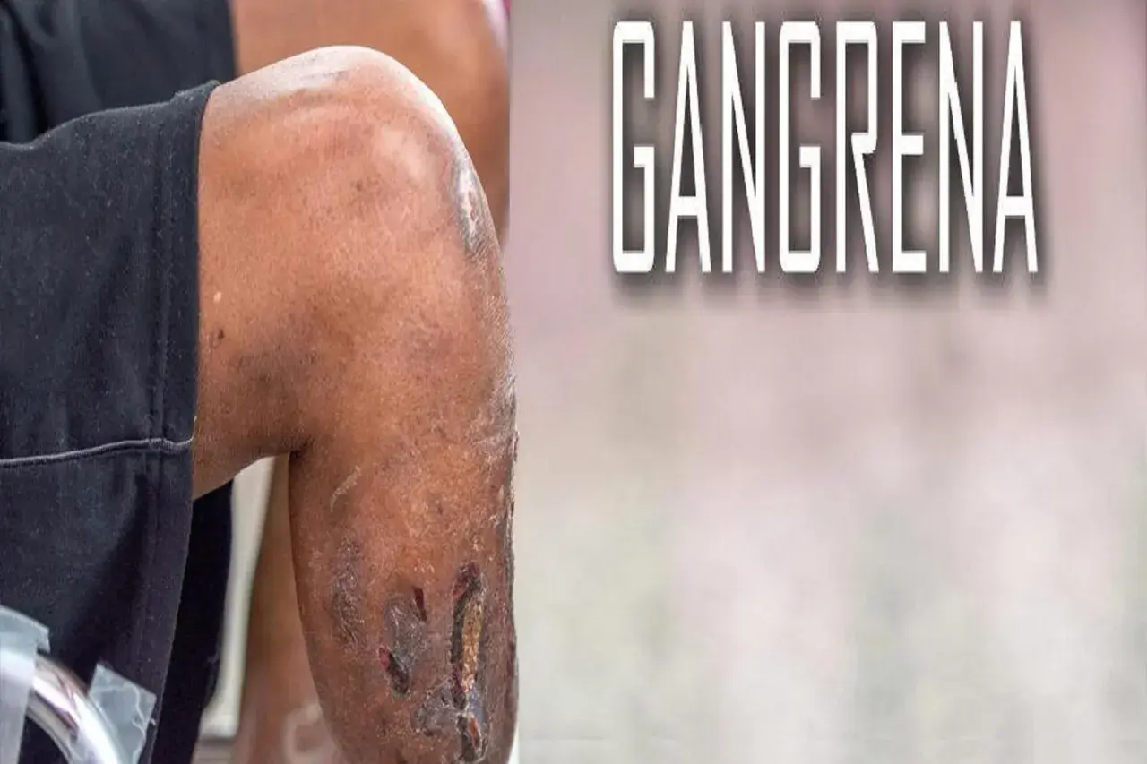 Fragment nogi z widocznymi ranami i tekstem "GANGRENA".