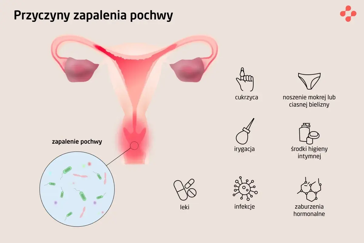 Ilustracja przedstawia przyczyny zapalenia pochwy: cukrzyca, wilgotna bielizna, irygacja, środki higieny intymnej, leki, infekcje, zaburzenia hormonalne. Widoczny jest powiększony obraz bakterii.