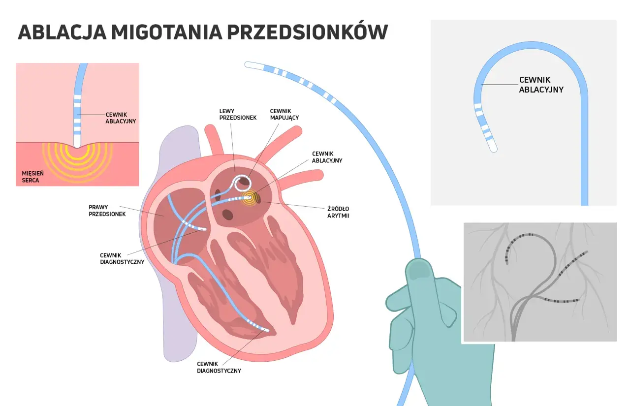 Ilustracja pokazuje, jak ablacja serca co to jest: cewniki wprowadzane do serca, by zlokalizować i zniszczyć źródło arytmii.