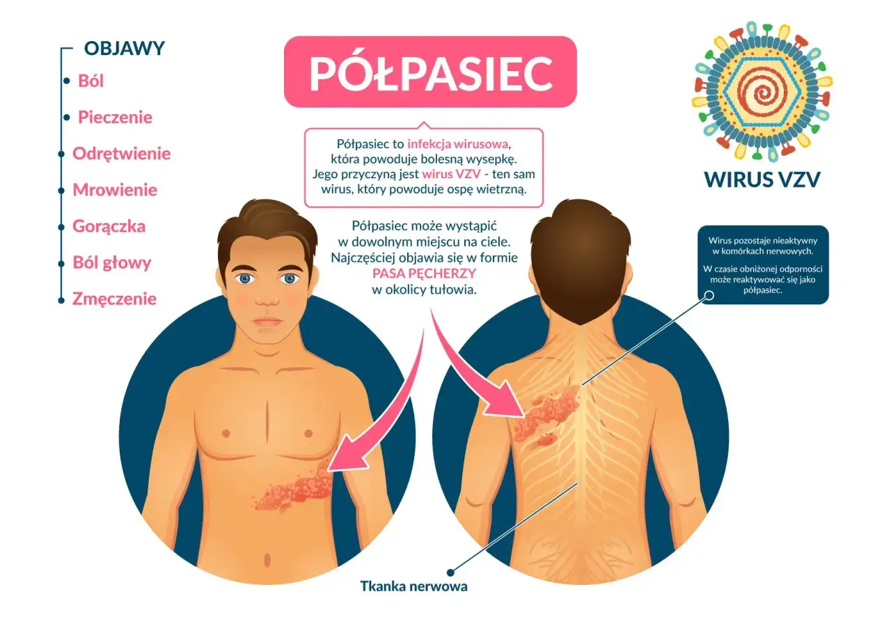Ilustracja przedstawia nietypowe objawy półpaśca: ból, pieczenie, mrowienie i wysypkę w formie pasa pęcherzy na tułowiu.