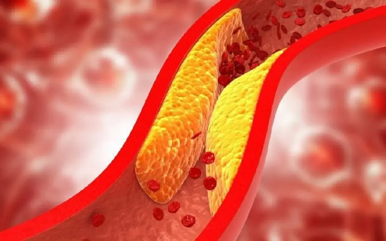 Złogi tłuszczowe zwężające naczynie krwionośne, utrudniające przepływ czerwonych krwinek. Lipoproteina a cena jest kluczowa w ocenie ryzyka sercowo-naczyniowego.