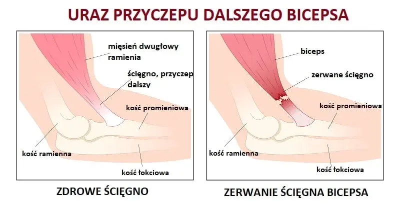 Naderwany biceps: 5 kluczowych objawów, które musisz znać
