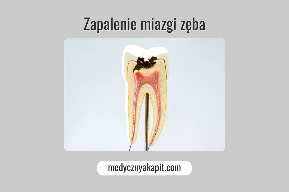 Model zęba ukazujący próchnicę sięgającą miazgi, co prowadzi do zapalenia miazgi.