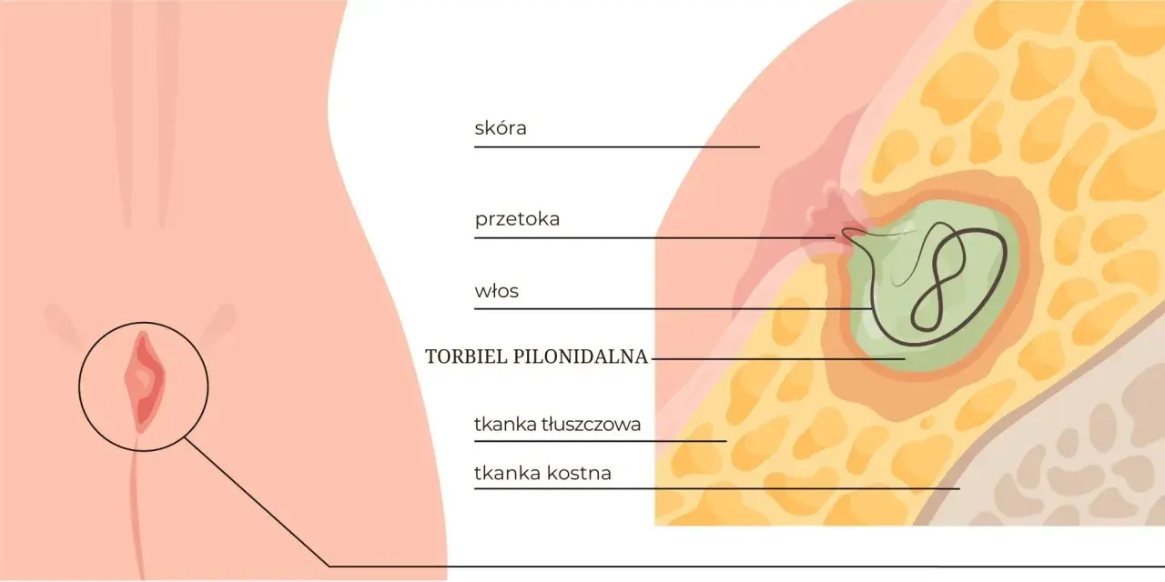 Ilustracja anatomiczna torbieli pilonidalnej z widocznym włosem i przetoką.