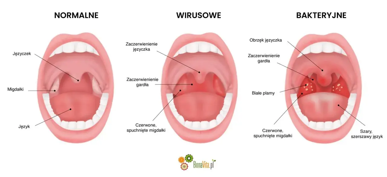 Porównanie gardła: normalne, wirusowe i bakteryjne. Widoczne migdałki, język i gardło.