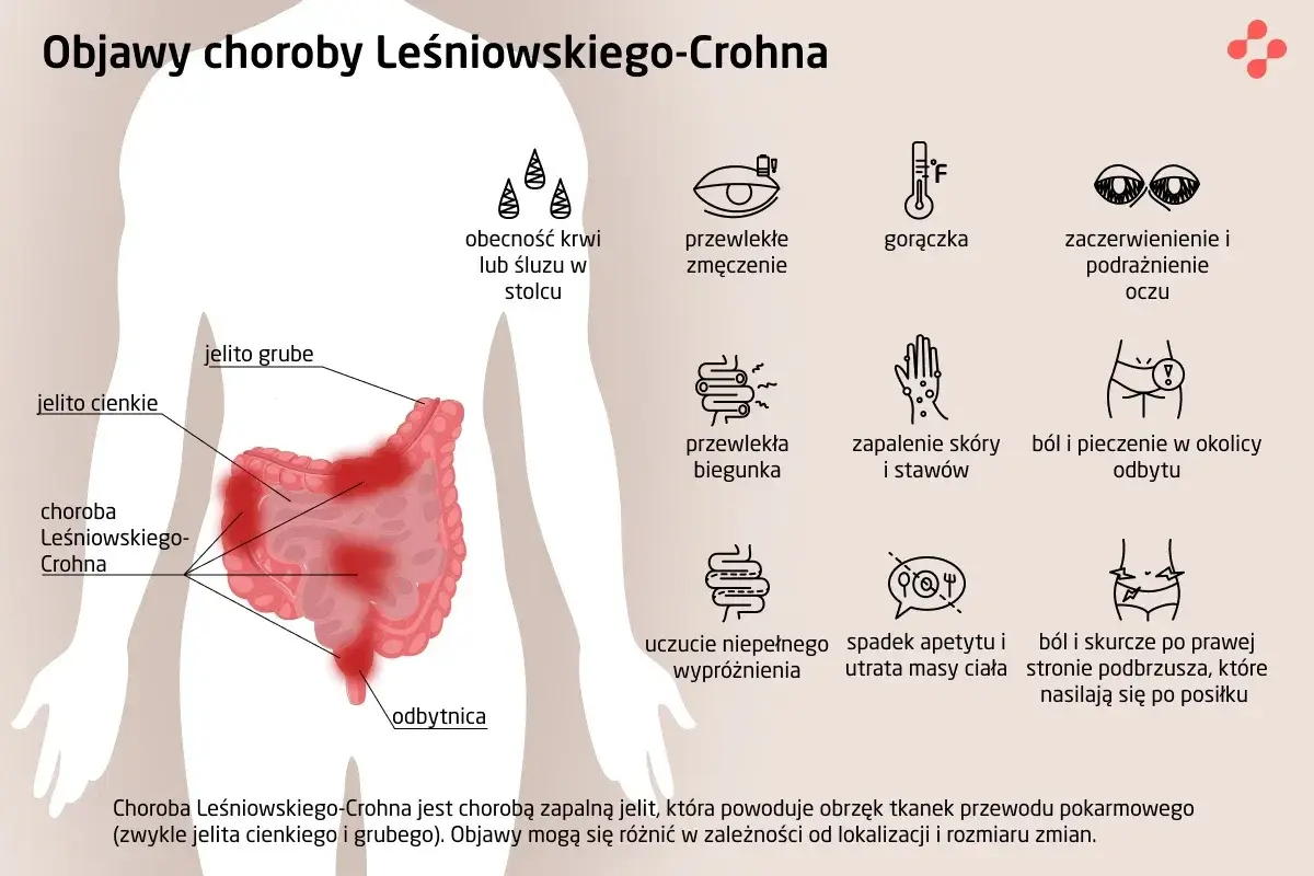 Ilustracja przedstawia schemat jelit z zaznaczonymi objawami choroby Leśniowskiego-Crohna.
