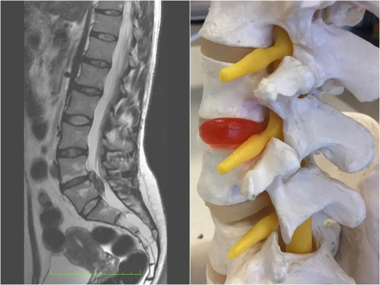 MRI kręgosłupa lędźwiowego i model anatomiczny ukazujący ucisk na nerw. Obraz pomaga zrozumieć zapalenie krążka międzykręgowego objawy.